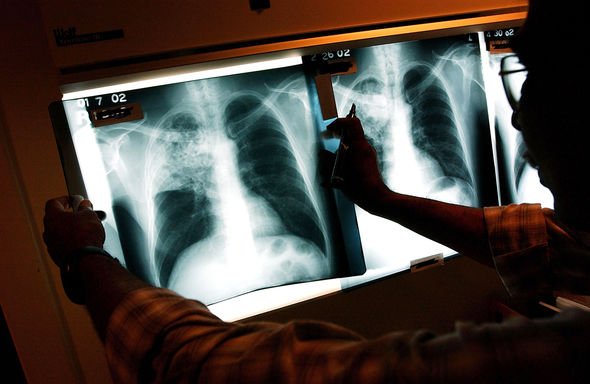 Médecin tenant les scanners pulmonaires d'un patient tuberculeux.