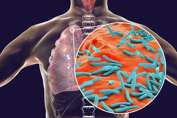 La bactérie de la tuberculose dans les poumons