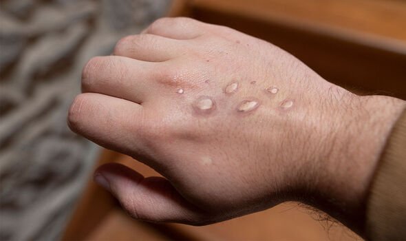 Lésions : les personnes infectées produisent des éruptions cutanées ou des lésions visibles sur la peau