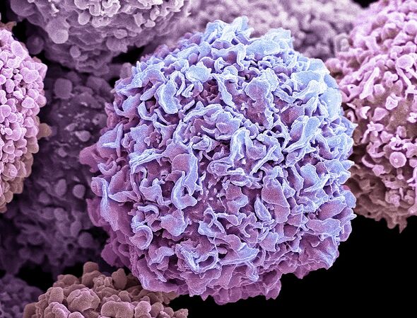 Une cellule cancéreuse du sein