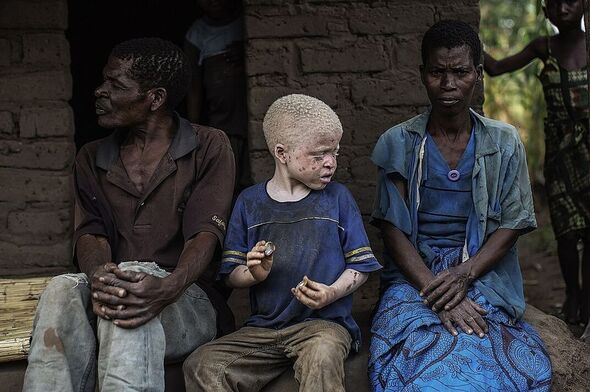 Enfant albinos 