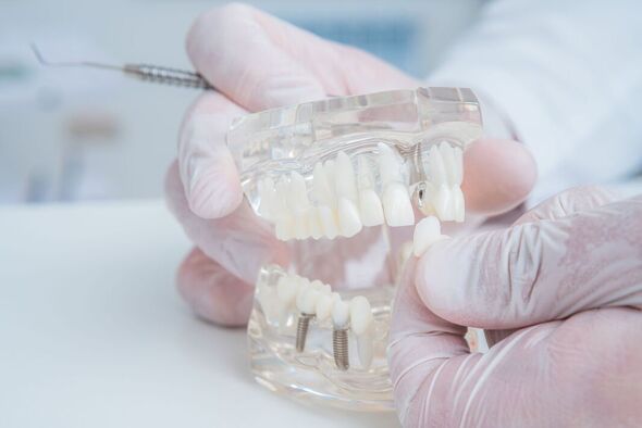 L'orthodontiste tient un modèle de dents avec des implants dans sa main et montre comment insérer la dent. Gros plan. Macro